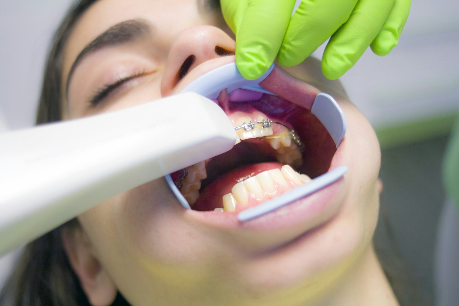 Braces treatment